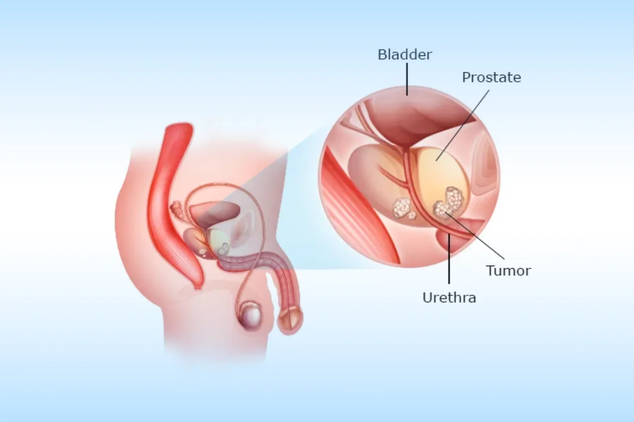 prostate problems - dr-aman-chandra hyderabad